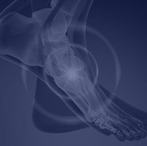 Pain on Top of Foot